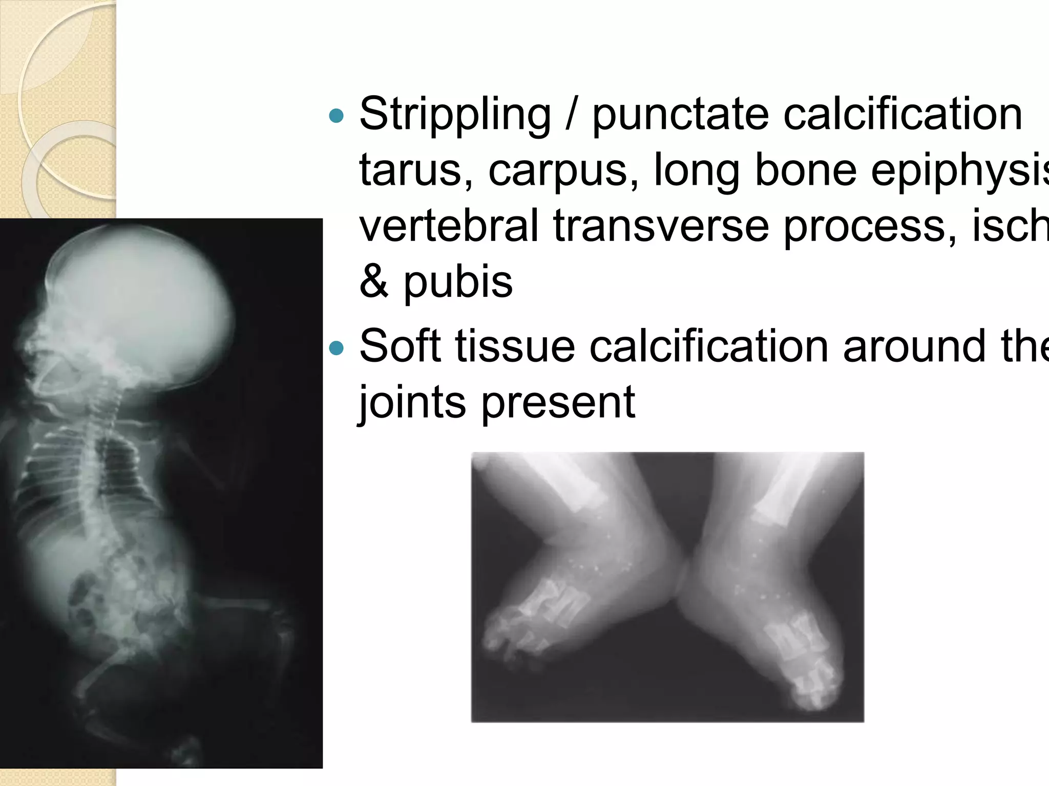  Strippling / punctate calcification 
tarus, carpus, long bone epiphysis, 
vertebral transverse process, ischium 
& pubis 
 Soft tissue calcification around the 
joints present 
 