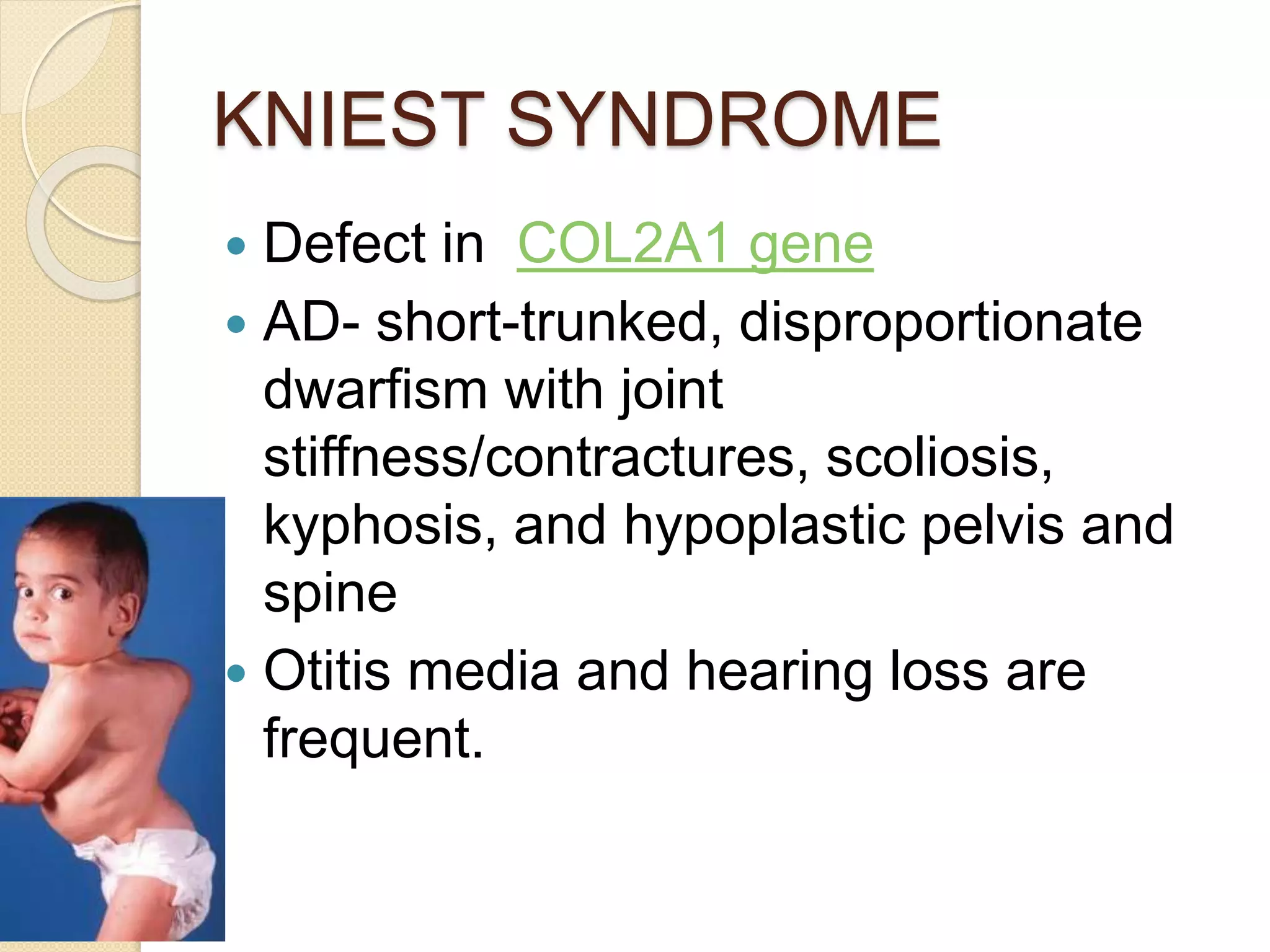 KNIEST SYNDROME 
 Defect in COL2A1 gene 
 AD- short-trunked, disproportionate 
dwarfism with joint 
stiffness/contractures, scoliosis, 
kyphosis, and hypoplastic pelvis and 
spine 
 Otitis media and hearing loss are 
frequent. 
 