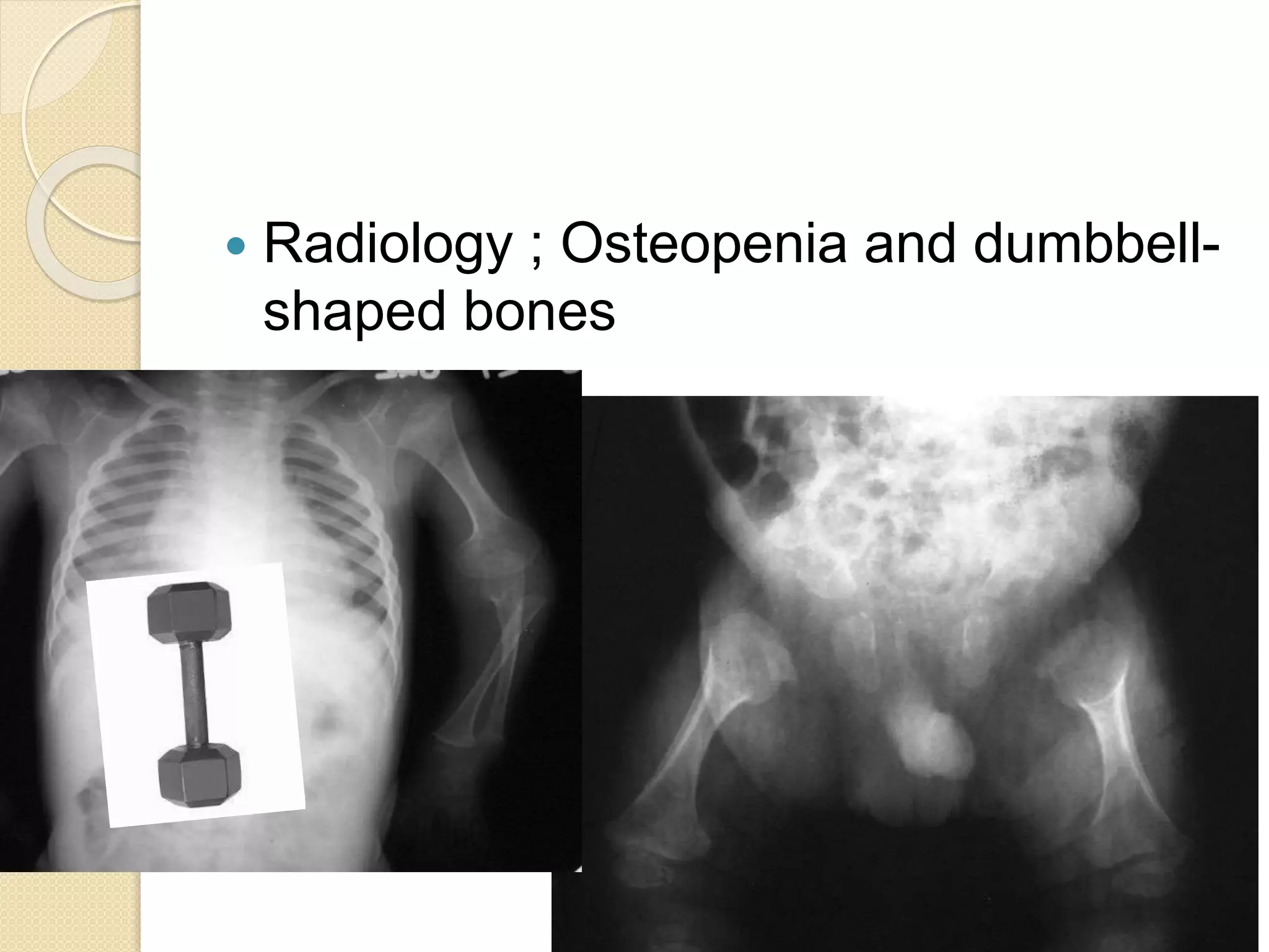  Radiology ; Osteopenia and dumbbell-shaped 
bones 
 