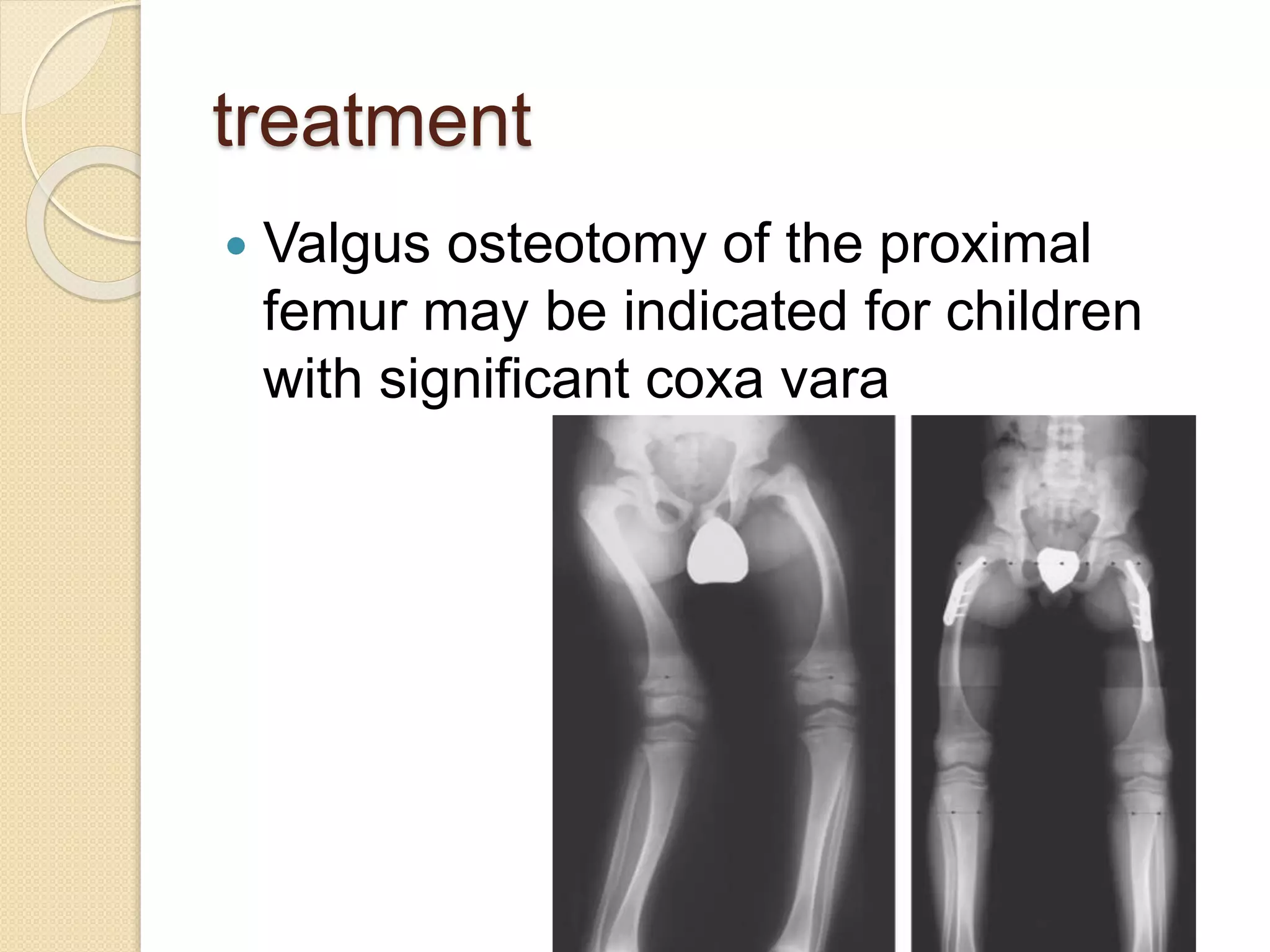 treatment 
 Valgus osteotomy of the proximal 
femur may be indicated for children 
with significant coxa vara 
 