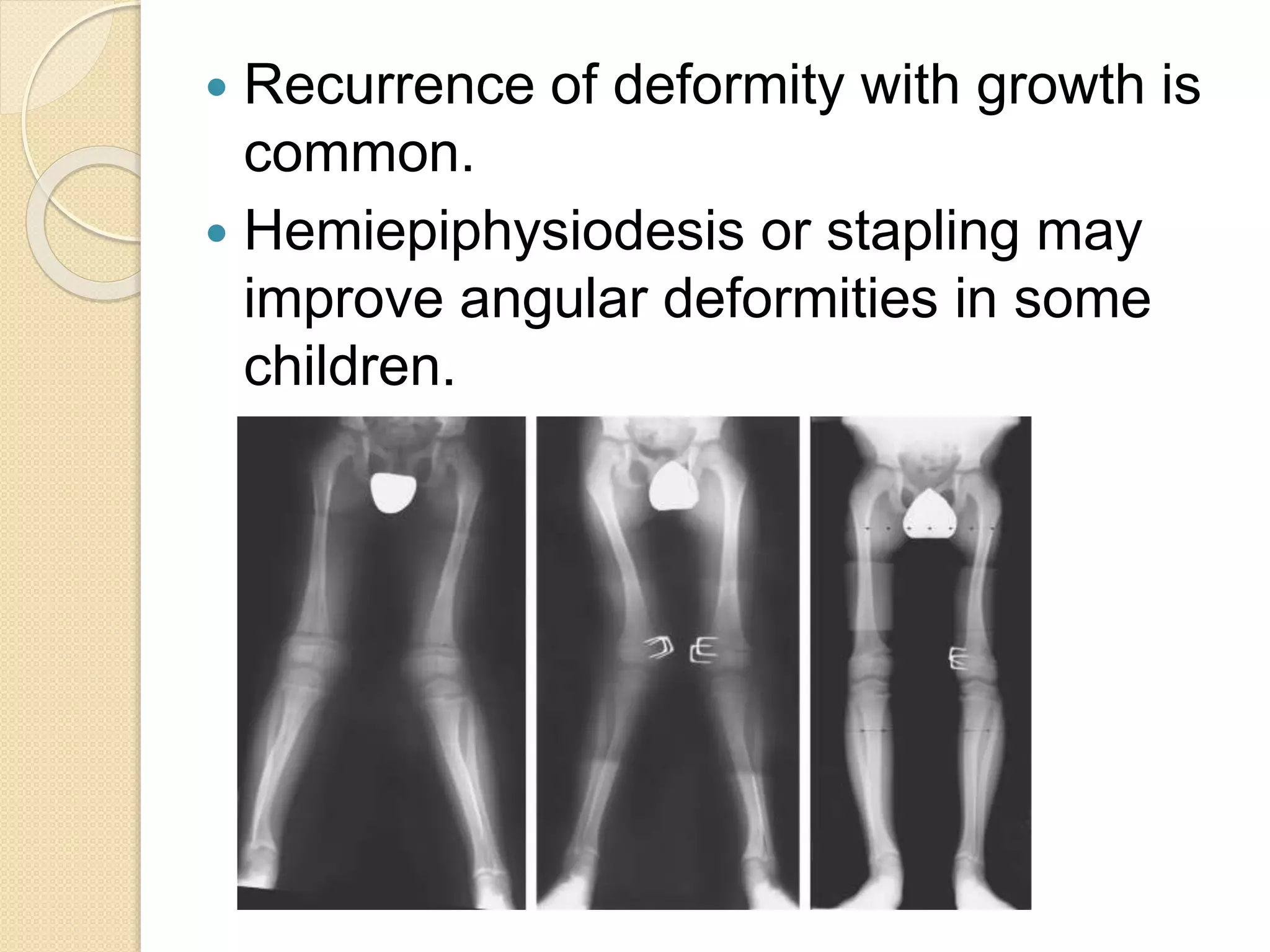  Recurrence of deformity with growth is 
common. 
 Hemiepiphysiodesis or stapling may 
improve angular deformities in some 
children. 
 