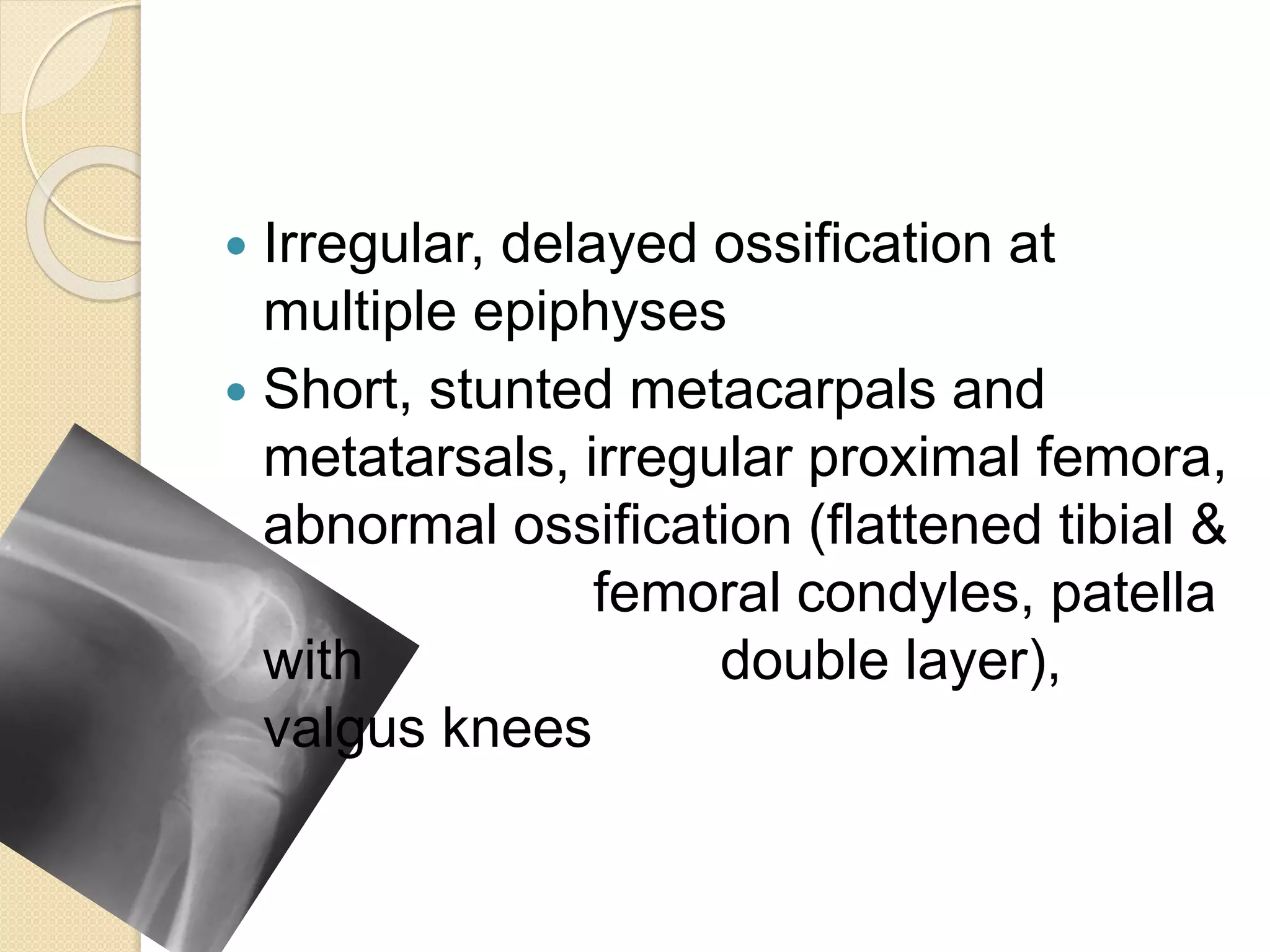  Irregular, delayed ossification at 
multiple epiphyses 
 Short, stunted metacarpals and 
metatarsals, irregular proximal femora, 
abnormal ossification (flattened tibial & 
femoral condyles, patella 
with double layer), 
valgus knees 
 