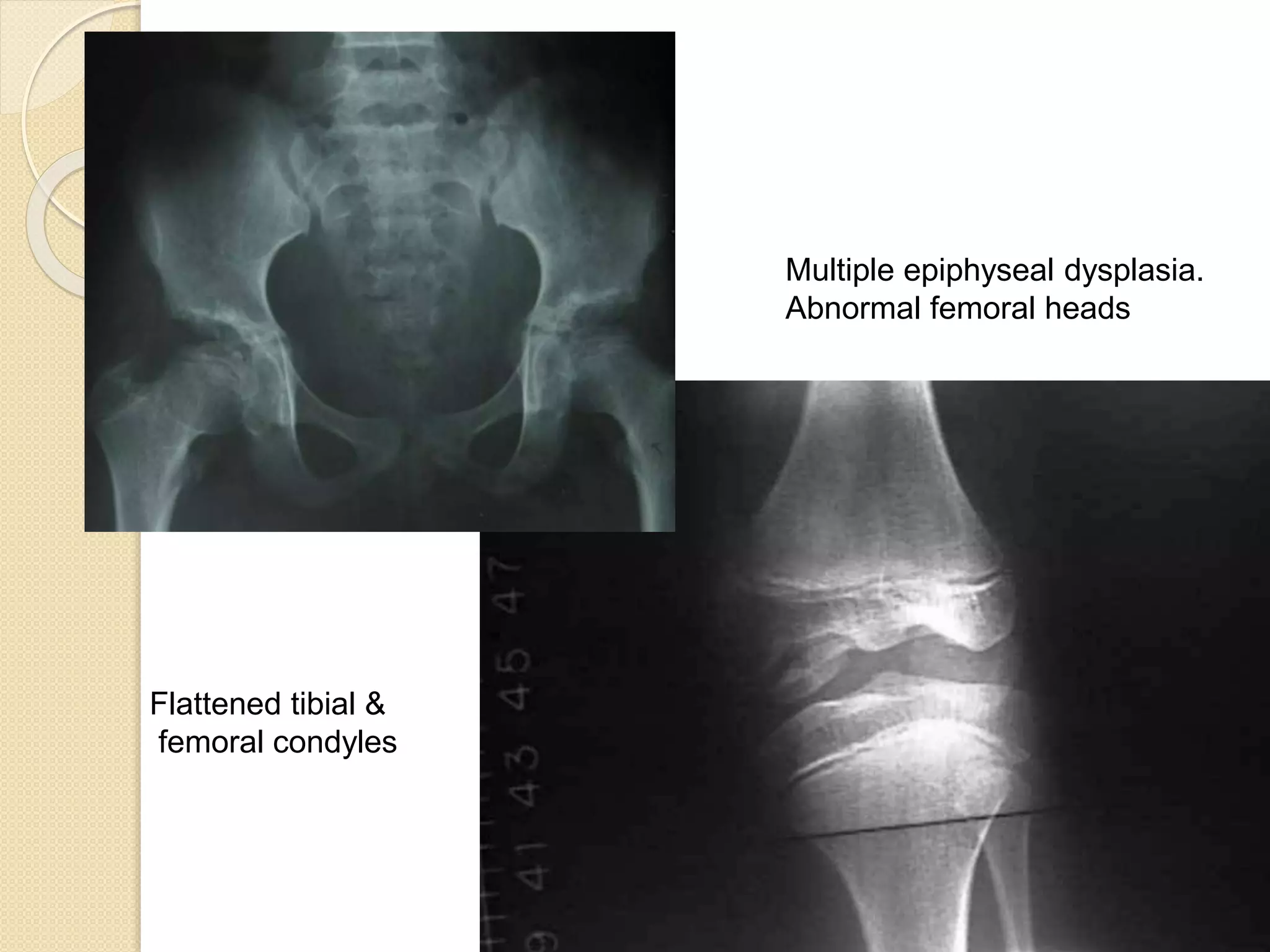 Multiple epiphyseal dysplasia. 
Abnormal femoral heads 
Flattened tibial & 
femoral condyles 
 