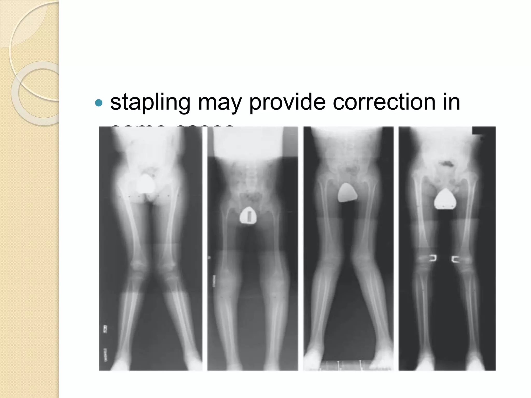  stapling may provide correction in 
some cases 
 