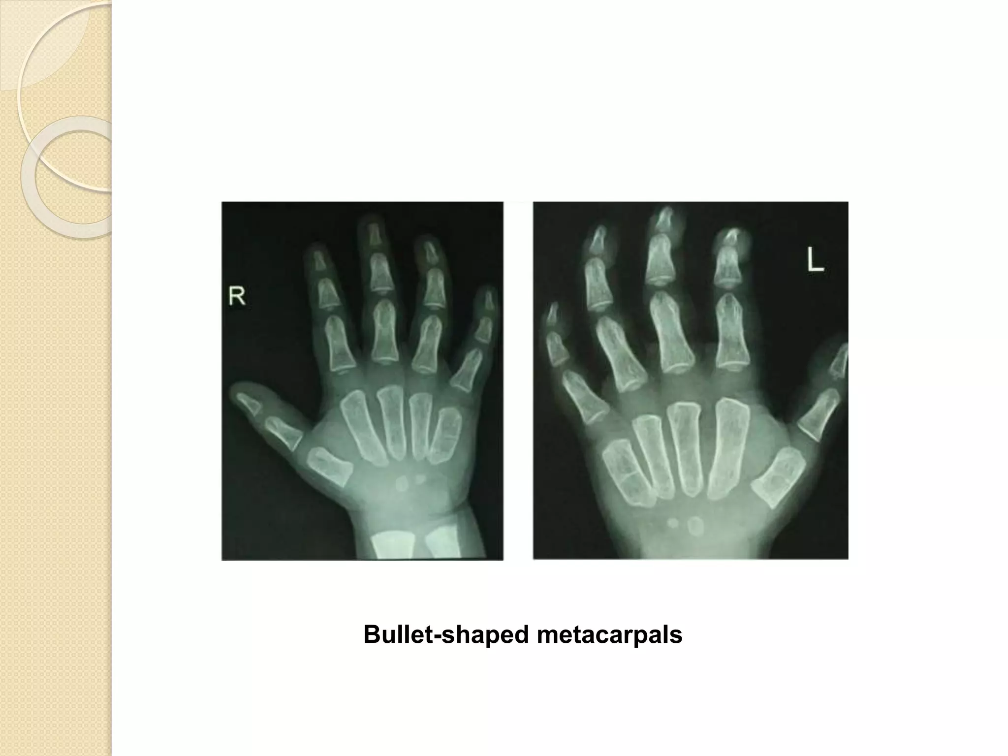 Bullet-shaped metacarpals 
 