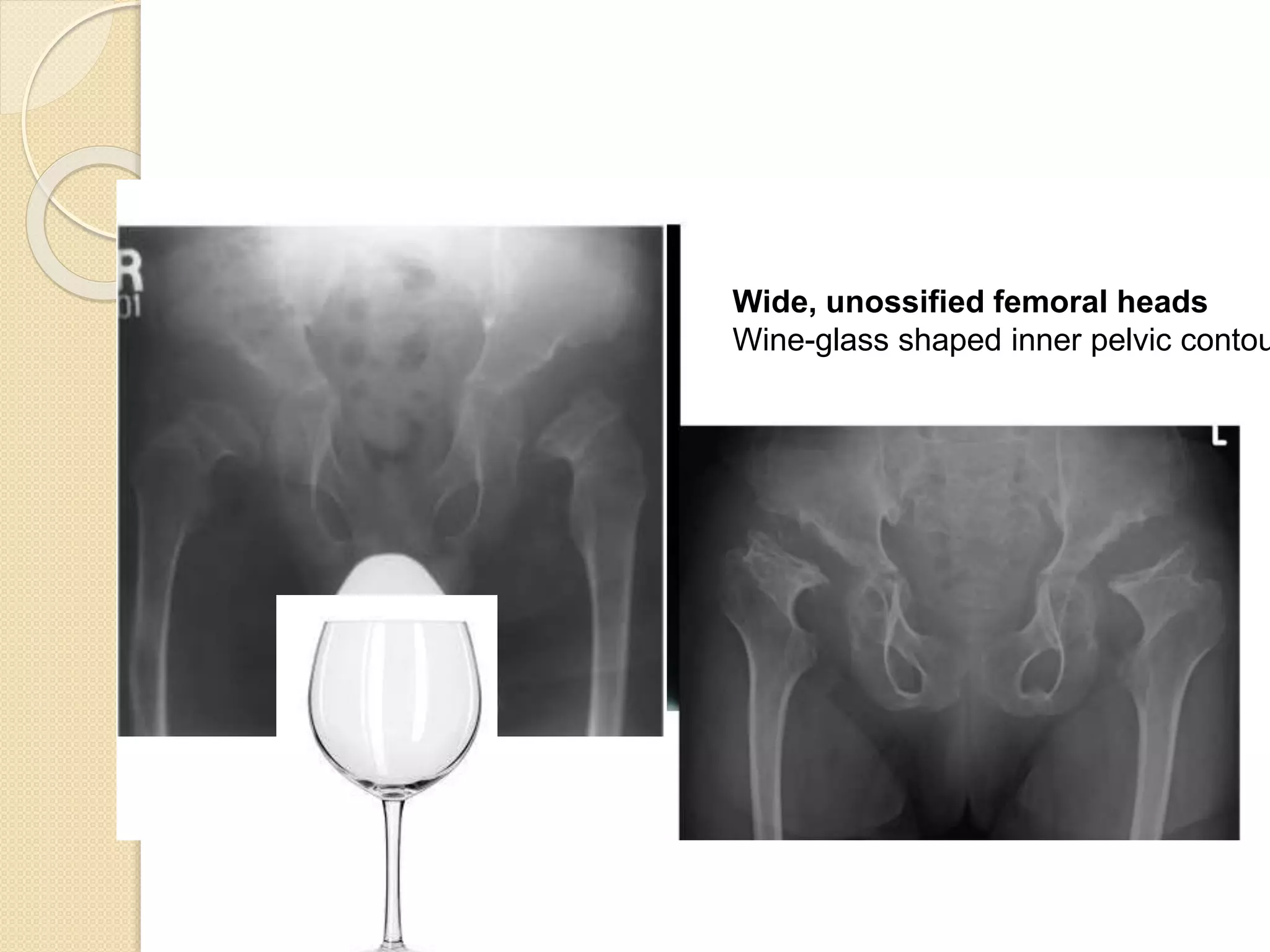 Wide, unossified femoral heads 
Wine-glass shaped inner pelvic contour 
 