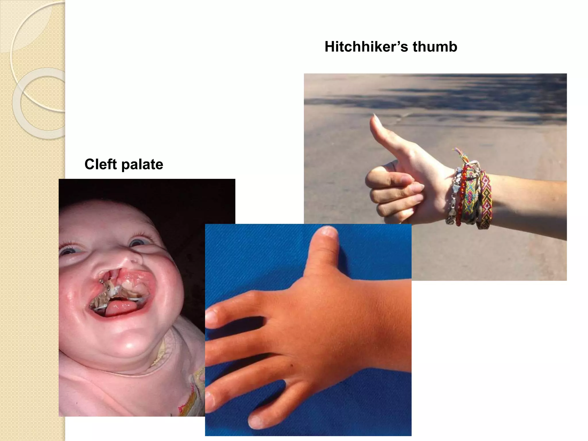 Hitchhiker’s thumb 
Cleft palate 
 
