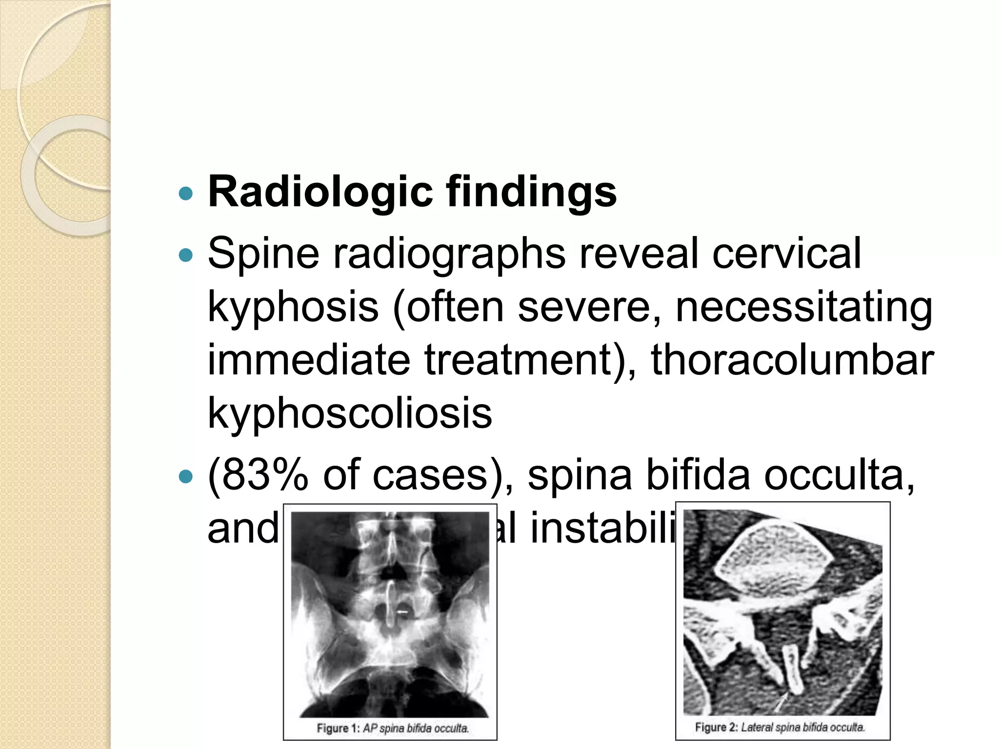  Radiologic findings 
 Spine radiographs reveal cervical 
kyphosis (often severe, necessitating 
immediate treatment), thoracolumbar 
kyphoscoliosis 
 (83% of cases), spina bifida occulta, 
and atlantoaxial instability. 
 