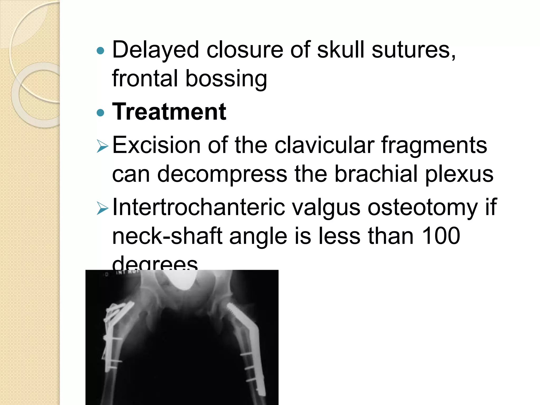  Delayed closure of skull sutures, 
frontal bossing 
 Treatment 
Excision of the clavicular fragments 
can decompress the brachial plexus 
Intertrochanteric valgus osteotomy if 
neck-shaft angle is less than 100 
degrees 
 