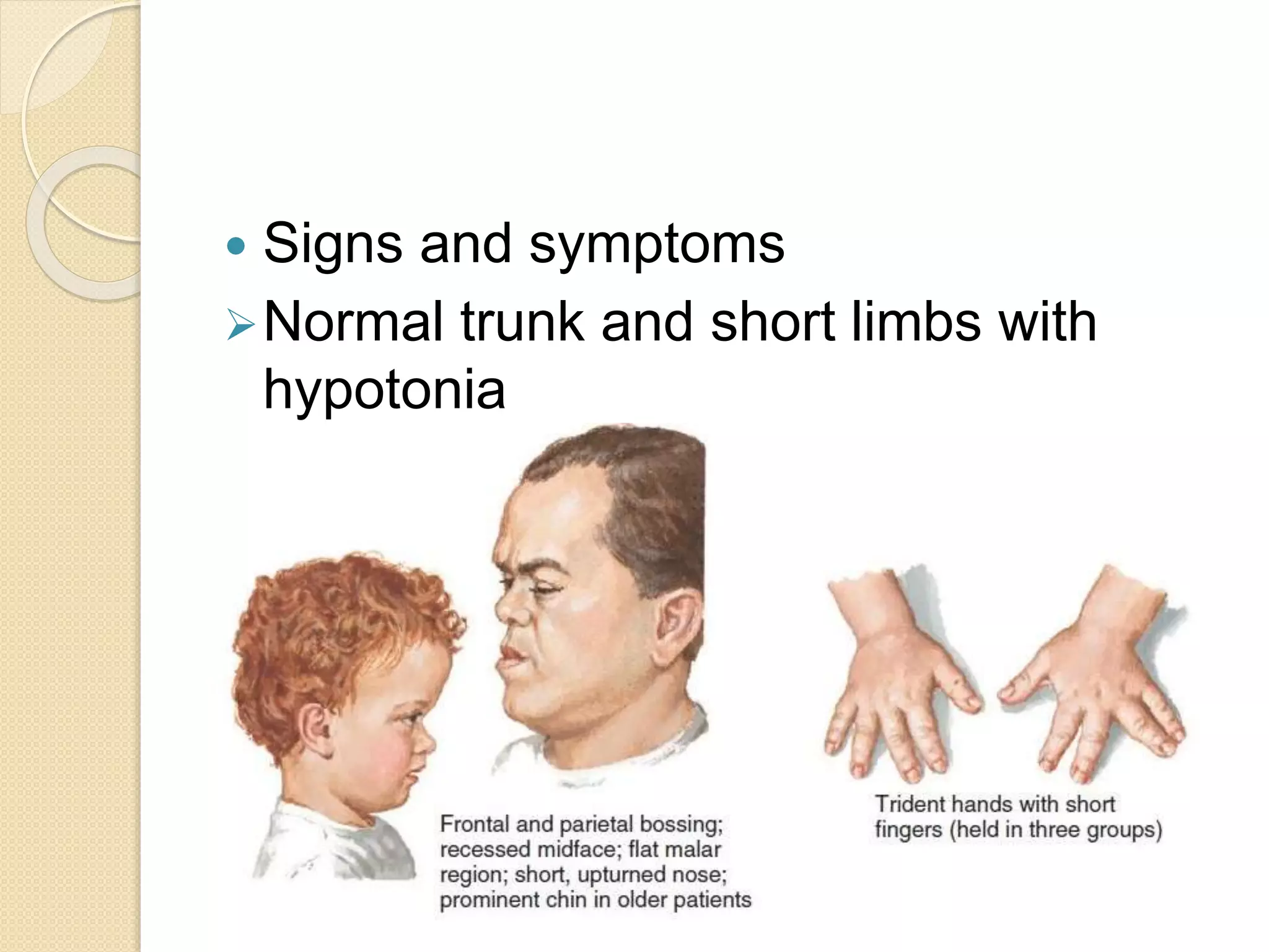  Signs and symptoms 
Normal trunk and short limbs with 
hypotonia 
 