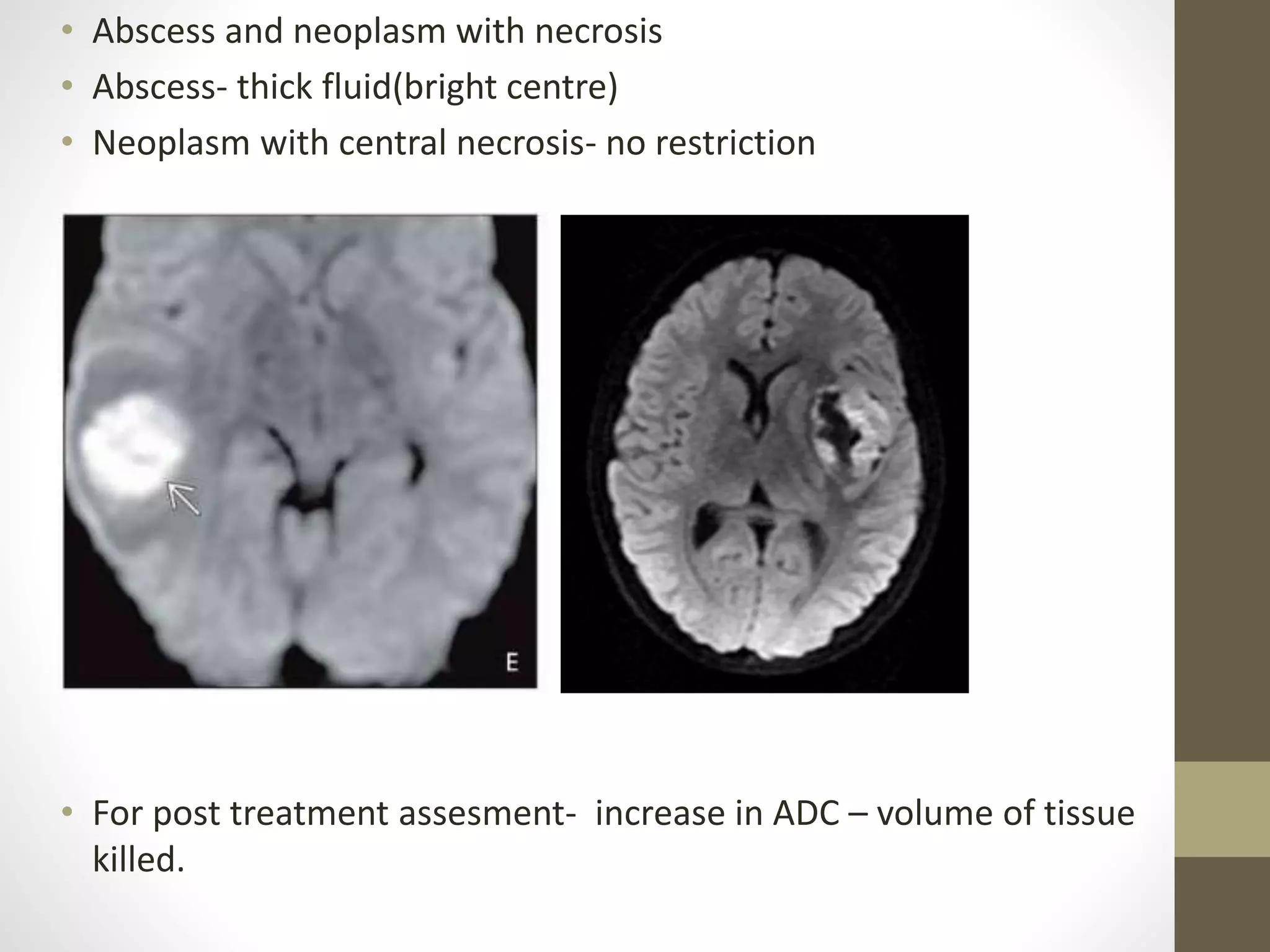 • Abscess and neoplasm with necrosis
• Abscess- thick fluid(bright centre)
• Neoplasm with central necrosis- no restriction
• For post treatment assesment- increase in ADC – volume of tissue
killed.
 