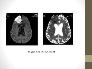 65 year male- Rt ACA Infarct
 