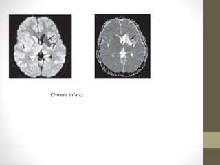 Chronic infarct
 