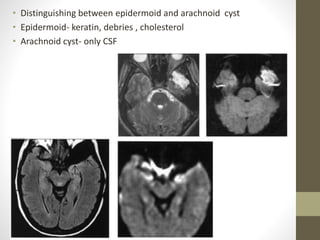 • Distinguishing between epidermoid and arachnoid cyst
• Epidermoid- keratin, debries , cholesterol
• Arachnoid cyst- only CSF
 