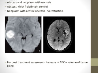 • Abscess and neoplasm with necrosis
• Abscess- thick fluid(bright centre)
• Neoplasm with central necrosis- no restriction
• For post treatment assesment- increase in ADC – volume of tissue
killed.
 
