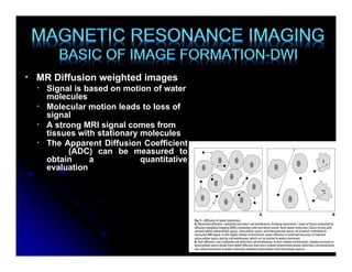 MR Diffusion weighted images is Signal b | PPTX