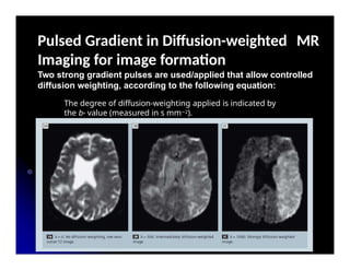 MR Diffusion weighted images is Signal b | PPTX