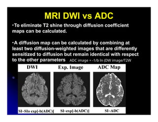 MR Diffusion weighted images is Signal b | PPTX