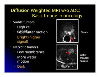 MR Diffusion weighted images is Signal b | PPTX