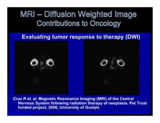 MR Diffusion weighted images is Signal b | PPTX
