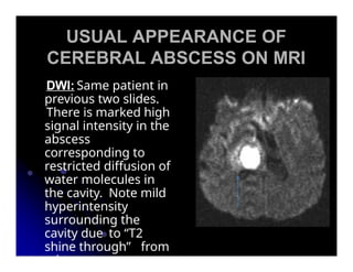 MR Diffusion weighted images is Signal b | PPTX