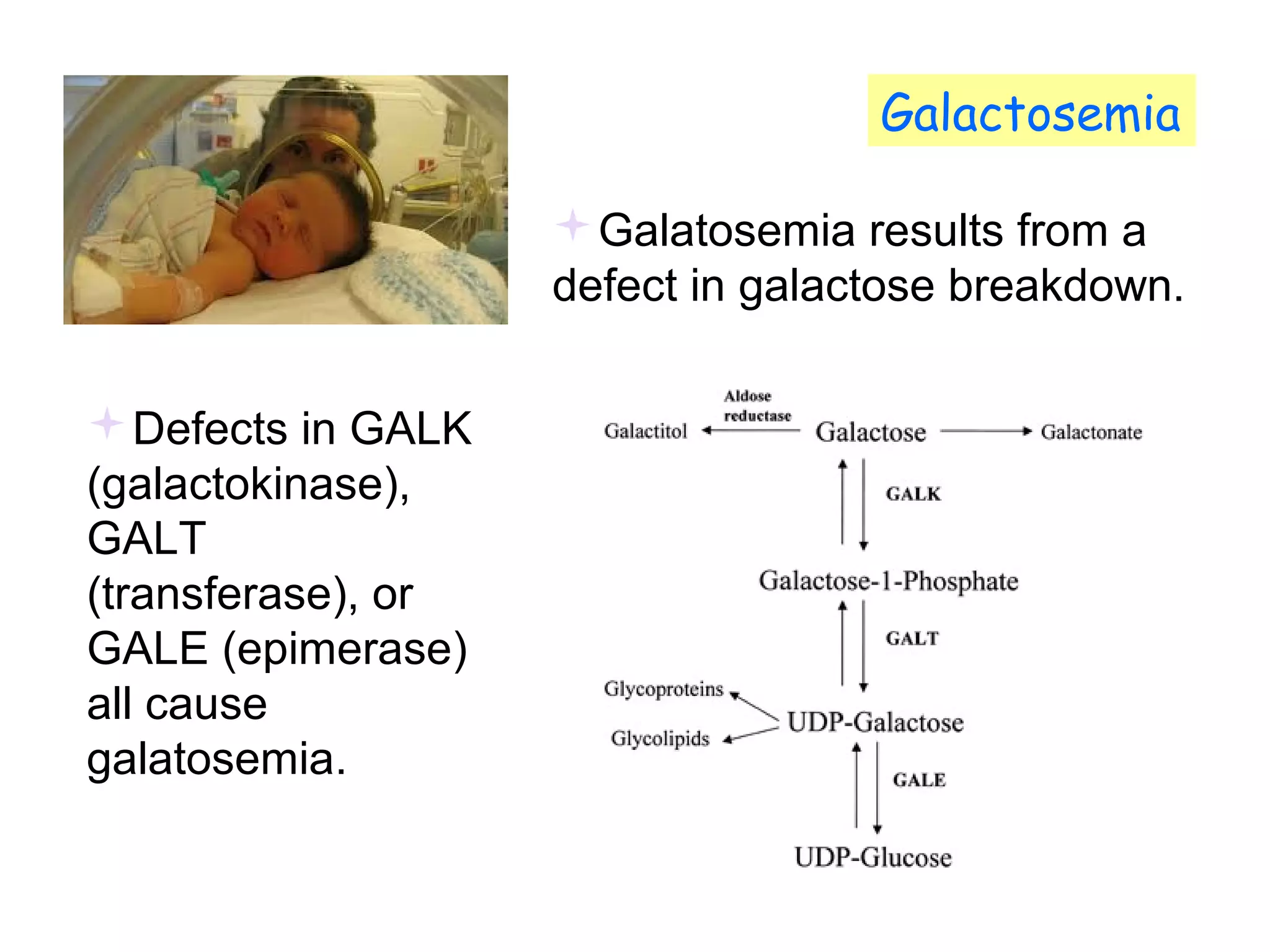 Galactosemia 
Galatosemia results from a 
defect in galactose breakdown. 
Defects in GALK 
(galactokinase), 
GALT 
(transferase), or 
GALE (epimerase) 
all cause 
galatosemia. 
 