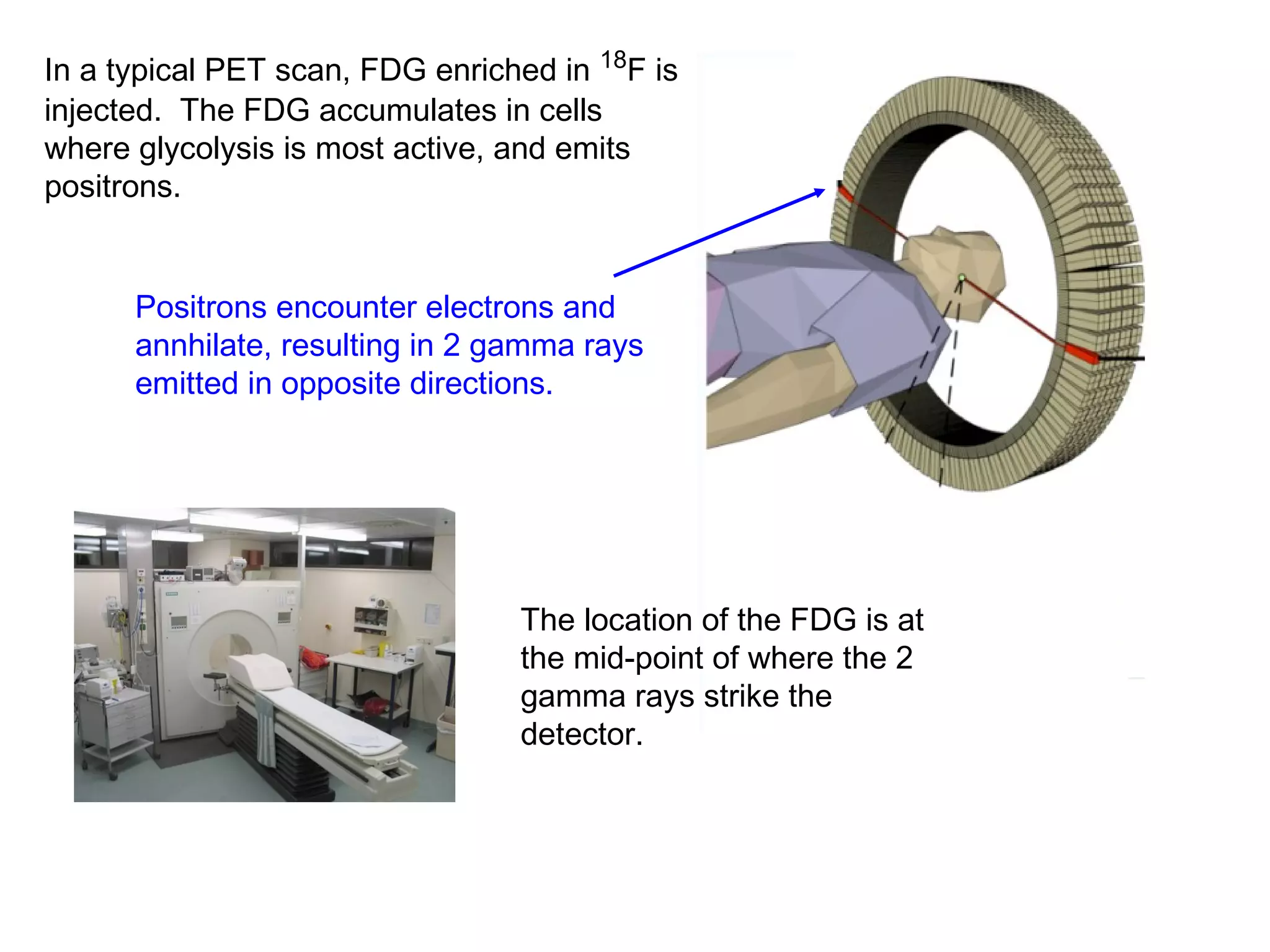 In a typical PET scan, FDG enriched in 18F is 
injected. The FDG accumulates in cells 
where glycolysis is most active, and emits 
positrons. 
Positrons encounter electrons and 
annhilate, resulting in 2 gamma rays 
emitted in opposite directions. 
The location of the FDG is at 
the mid-point of where the 2 
gamma rays strike the 
detector. 
 