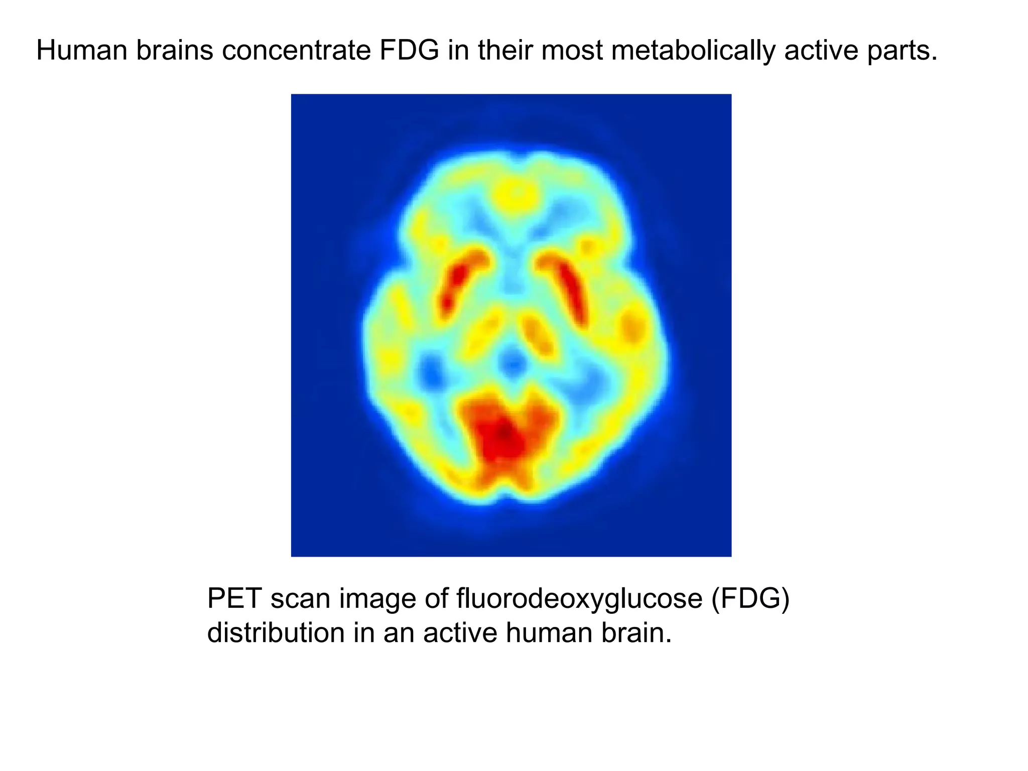 Human brains concentrate FDG in their most metabolically active parts. 
PET scan image of fluorodeoxyglucose (FDG) 
distribution in an active human brain. 
 