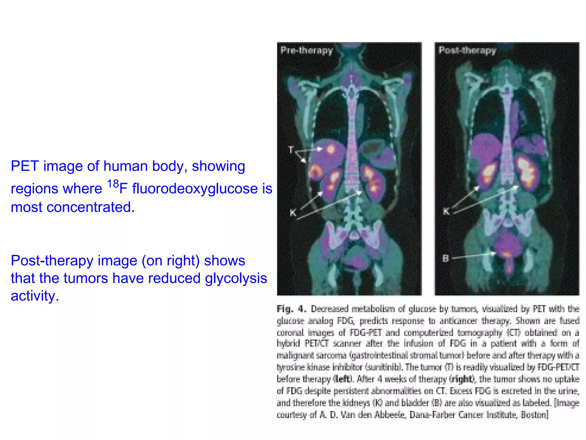 PET image of human body, showing 
regions where 18F fluorodeoxyglucose is 
most concentrated. 
Post-therapy image (on right) shows 
that the tumors have reduced glycolysis 
activity. 
