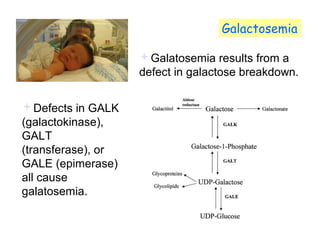 Galactosemia 
Galatosemia results from a 
defect in galactose breakdown. 
Defects in GALK 
(galactokinase), 
GALT 
(transferase), or 
GALE (epimerase) 
all cause 
galatosemia. 
 