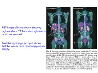 PET image of human body, showing 
regions where 18F fluorodeoxyglucose is 
most concentrated. 
Post-therapy image (on right) shows 
that the tumors have reduced glycolysis 
activity. 
