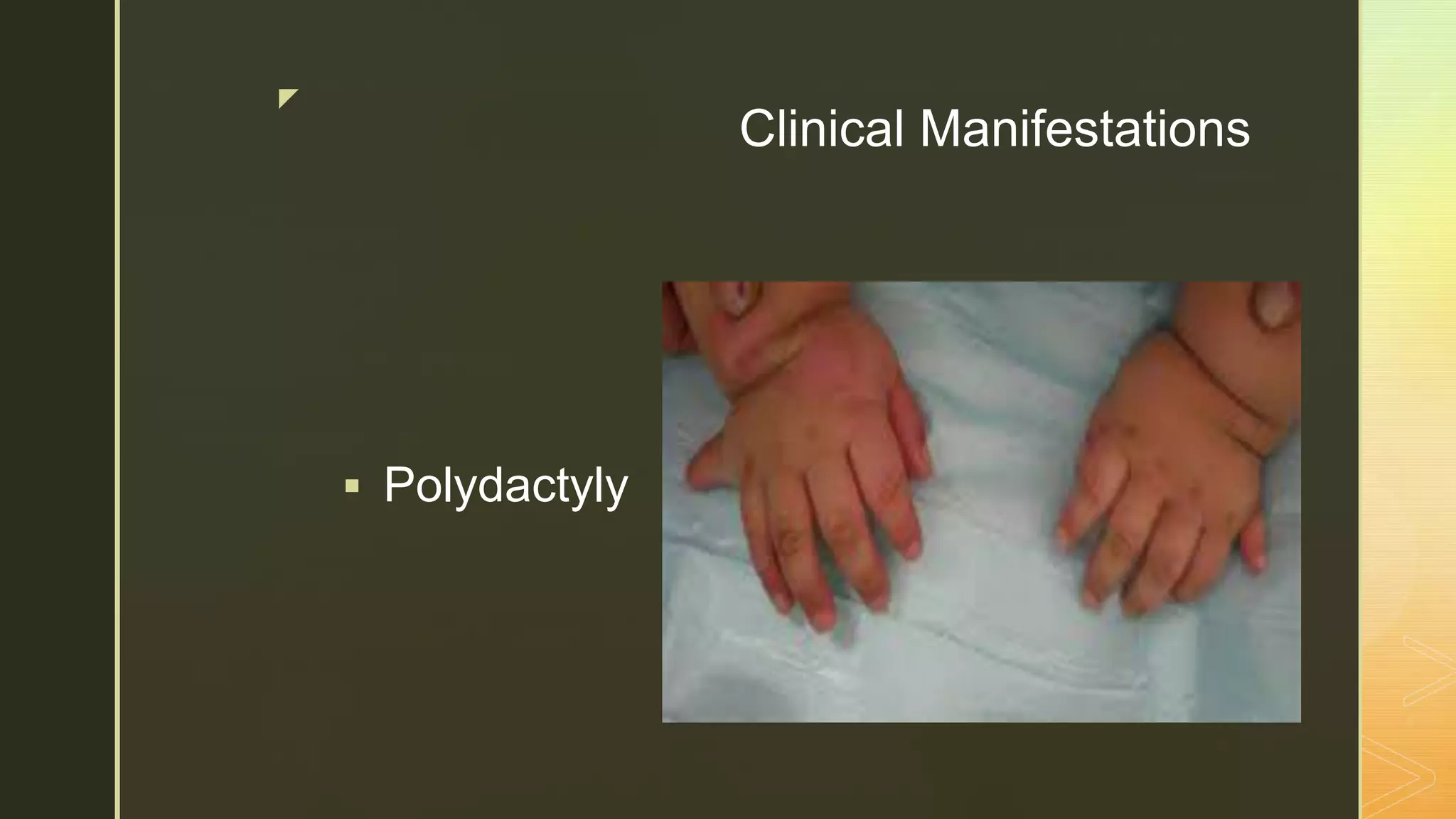 z
Clinical Manifestations
 Polydactyly
 