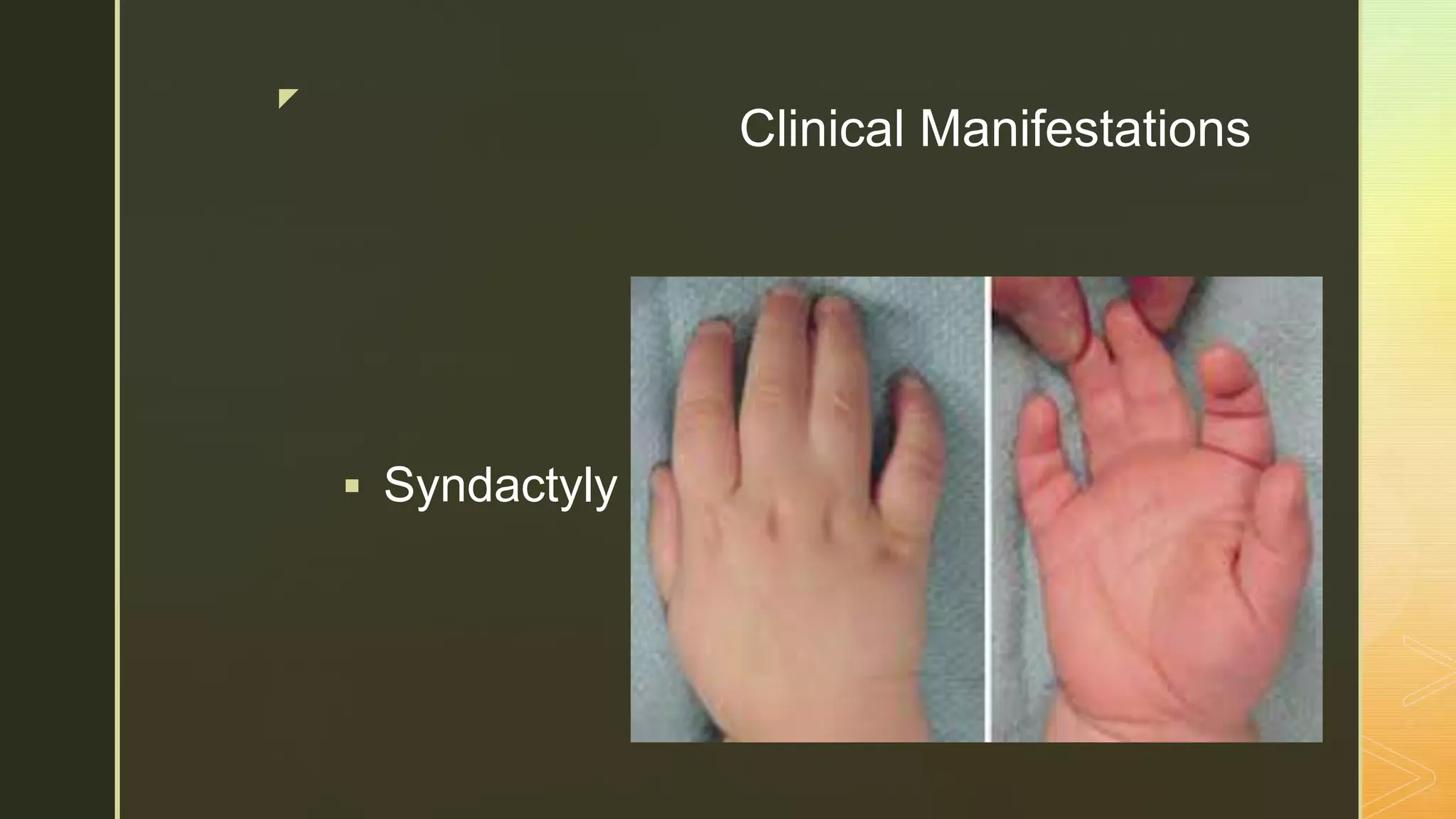 z
Clinical Manifestations
 Syndactyly
 