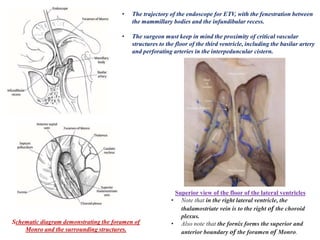 Schematic diagram demonstrating the foramen of
Monro and the surrounding structures.
• The trajectory of the endoscope for ETV, with the fenestration between
the mammillary bodies and the infundibular recess.
• The surgeon must keep in mind the proximity of critical vascular
structures to the floor of the third ventricle, including the basilar artery
and perforating arteries in the interpeduncular cistern.
Superior view of the floor of the lateral ventricles
• Note that in the right lateral ventricle, the
thalamostriate vein is to the right of the choroid
plexus.
• Also note that the fornix forms the superior and
anterior boundary of the foramen of Monro.
 