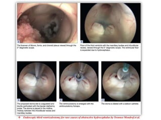  Endoscopic third ventriculostomy for rare causes of obstructive hydrocephalus by Yvonnee Mondrof et al.
 