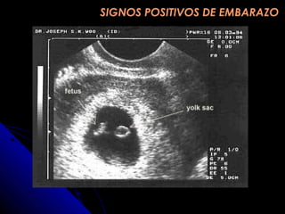 SIGNOS POSITIVOS DE EMBARAZOSIGNOS POSITIVOS DE EMBARAZO
 