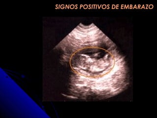 SIGNOS POSITIVOS DE EMBARAZOSIGNOS POSITIVOS DE EMBARAZO
 