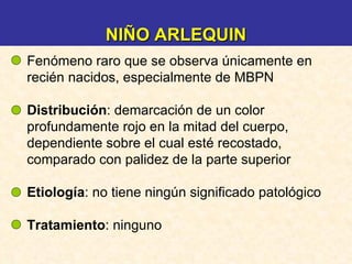 Fenómeno raro que se observa únicamente en recién nacidos, especialmente de MBPN Distribución : demarcación de un color profundamente rojo en la mitad del cuerpo, dependiente sobre el cual esté recostado, comparado con palidez de la parte superior Etiología : no tiene ningún significado patológico Tratamiento : ninguno NIÑO ARLEQUIN 