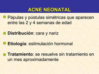 Pápulas y pústulas simétricas que aparecen entre las 2 y 4 semanas de edad Distribución : cara y nariz Etiología : estimulación hormonal Tratamiento : se resuelve sin tratamiento en un mes aproximadamente ACNE NEONATAL 