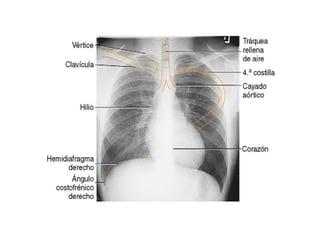 Exploracion de la radiografia de torax tecnicamente aceptable Slide 18