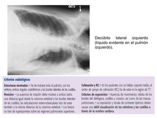 Exploracion de la radiografia de torax tecnicamente aceptable Slide 26
