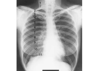 Exploracion de la radiografia de torax tecnicamente aceptable Slide 8