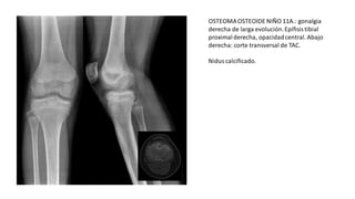 OSTEOMAOSTEOIDE NIÑO 11A.: gonalgia
derecha de larga evolución.Epífisis tibial
proximalderecha, opacidadcentral. Abajo
derecha: corte transversal de TAC.
Nidus calcificado.
 