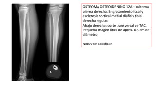 OSTEOMA OSTEOIDE NIÑO 12A.: bultoma
pierna derecha. Engrosamiento focal y
esclerosis cortical medial diáfisis tibial
derecha regular.
Abajo derecha: corte transversal de TAC.
Pequeña imagen lítica de aprox. 0.5 cm de
diámetro.
Nidus sin calcificar
 