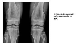 OSTEOCONDROMATOSIS
MÚLTIPLE EN NIÑA DE
13A.
 