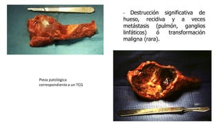 Pieza patológica
correspondientea un TCG
- Destrucción significativa de
hueso, recidiva y a veces
metástasis (pulmón, ganglios
linfáticos) ó transformación
maligna (rara).
 