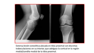Extensa lesión osteolíticaubicada en tibia proximal con discretas
trabeculaciones en su interior, que adelgaza la cortical en la región
medial/condilo medial de la tibia proximal.
 
