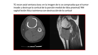 TC recon axial ventana ósea: en la imagen de tc se comprueba que el tumor
invade y destruye la cortical de la porción medial de tibia proximal/ RM
sagital lesión lítica isointensa con destrucción de la cortical
 
