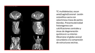 TC multidetector, recon
axial/sagital/coronal: Lesión
osteolítica sacra con
voluminosa masa de partes
blandas. Presentadensidad
heterogenea con
calcificaciones centrales y
áreas de degeneración
quística en su interior.
Observese el globo vesical
secundario a la compresión
de estructuras vecinas.
 
