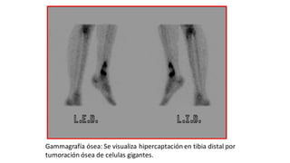 Gammagrafía ósea: Se visualiza hipercaptación en tibia distal por
tumoración ósea de celulas gigantes.
 